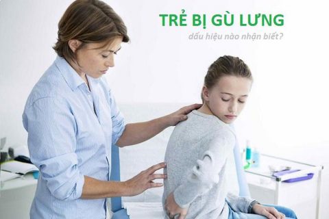 dấu hiệu của gù lưng ở trẻ em