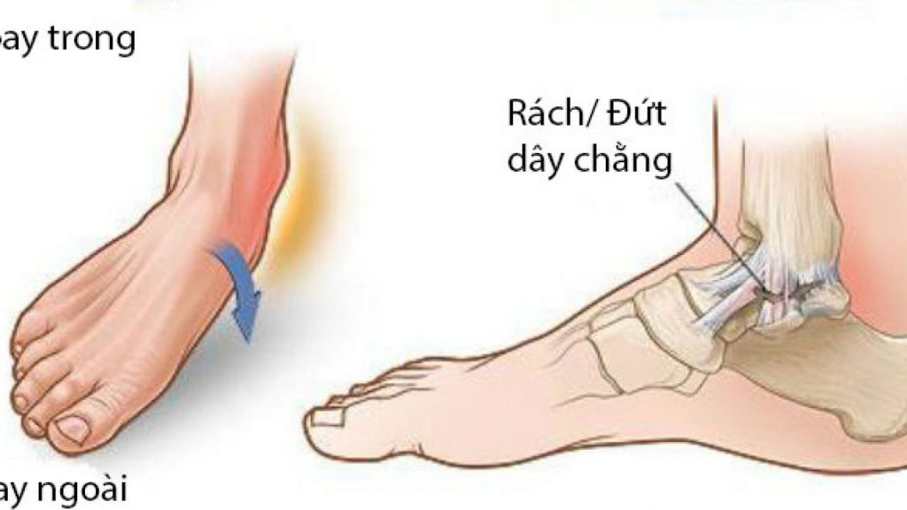 Băng bảo vệ cổ chân- Giải pháp tránh chấn thương bóng đá